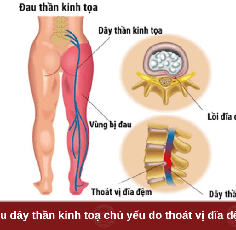 Đau Dây Thần Kinh Tọa Là Gì? Mẹo Dân Gian Giảm Đau Hiệu Quả